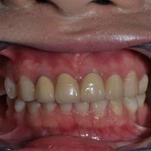 保定東陽口腔醫(yī)院張亞靜醫(yī)生做牙齒冷光美白怎么樣？附冷光美白案例效果對(duì)比圖