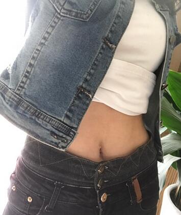 保定現(xiàn)代女子醫(yī)院整形美容中心做腰腹部吸脂怎么樣？附林秀蓮醫(yī)生案例效果圖
