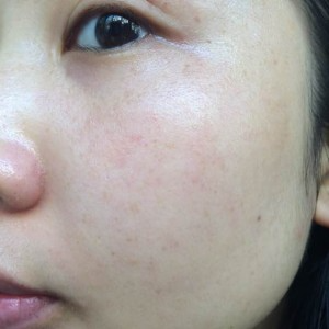 寶雞皮膚病醫(yī)院文東亮醫(yī)生做臉部祛斑效果怎么樣？附臉部祛斑案例