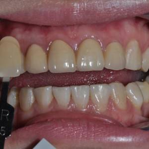 保定東陽口腔醫(yī)院張亞靜醫(yī)生做牙齒冷光美白怎么樣？附冷光美白案例效果對(duì)比圖