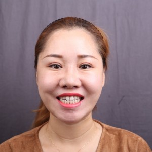 保定東陽口腔醫(yī)院趙晨醫(yī)生做瓷貼面怎么樣?附瓷貼面案例效果對比圖