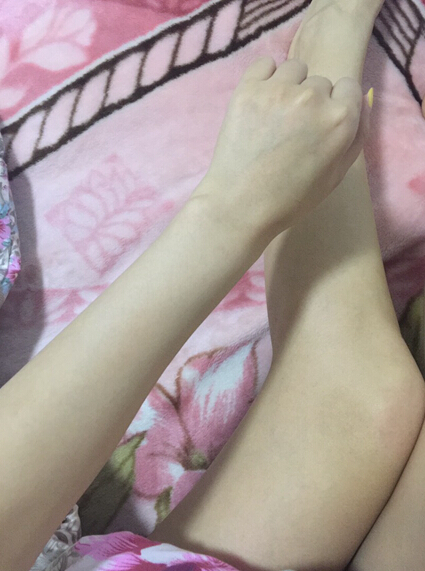 蚌埠市第三人民醫(yī)院燒傷整形科李方奇注射美白針效果怎么樣？安全嗎？附案例