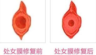 蚌埠市第三人民醫(yī)院燒傷整形科許瑾醫(yī)生做處女摸修復(fù)怎么樣？附案例