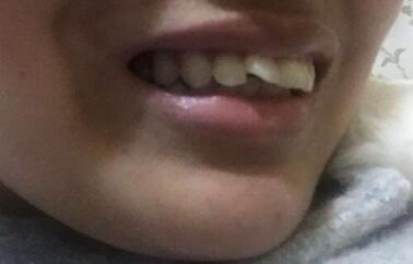 保定東陽口腔醫(yī)院馮春城醫(yī)生做烤瓷牙怎么樣？附烤瓷牙案例效果對(duì)比圖