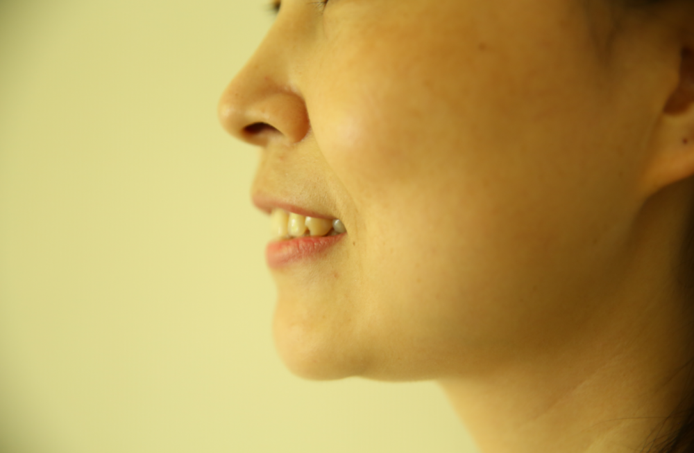 保定東陽口腔醫(yī)院趙星醫(yī)生做牙齒瓷貼面怎么樣？附牙齒瓷貼面案例效果對比圖