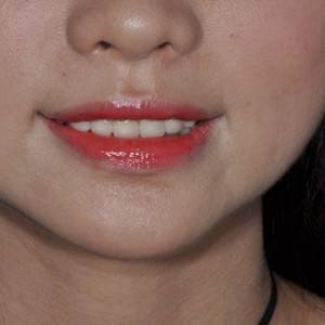 保定東陽口腔醫(yī)院張亞靜醫(yī)生做牙齒冷光美白怎么樣？附冷光美白案例效果對(duì)比圖