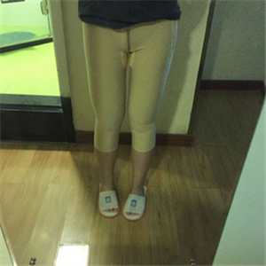 保定市第五醫(yī)院美容整形科做大腿吸脂怎么樣？附劉根立醫(yī)生案例效果圖