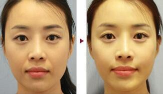 保定安卓貝拉做注射去法令紋怎么樣？附儲君醫(yī)生法令紋案例效果圖