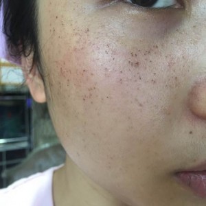 寶雞皮膚病醫(yī)院文東亮醫(yī)生做臉部祛斑效果怎么樣？附臉部祛斑案例