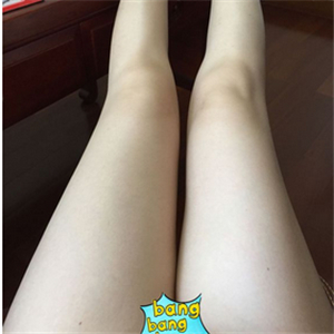 保定市第五醫(yī)院美容整形科做大腿吸脂怎么樣？附劉根立醫(yī)生案例效果圖