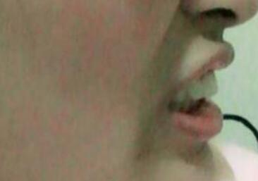 保定東陽口腔醫(yī)院馮春城醫(yī)生做烤瓷牙怎么樣?附烤瓷牙案例效果對比圖 保定東陽口腔醫(yī)院馮春城醫(yī)生做烤瓷牙怎么樣?附烤瓷牙案例效果對比圖