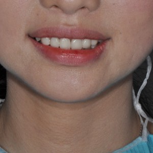 保定東陽口腔醫(yī)院張亞靜醫(yī)生做牙齒冷光美白怎么樣？附冷光美白案例效果對(duì)比圖