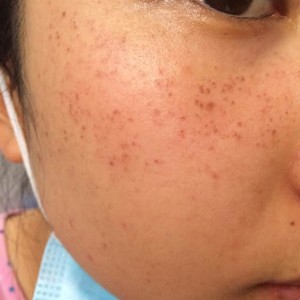 寶雞皮膚病醫(yī)院文東亮醫(yī)生做臉部祛斑效果怎么樣？附臉部祛斑案例