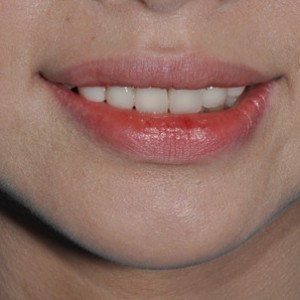 保定東陽口腔醫(yī)院張亞靜醫(yī)生做牙齒冷光美白怎么樣？附冷光美白案例效果對(duì)比圖