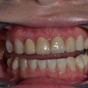 保定東陽口腔醫(yī)院張亞靜醫(yī)生做牙齒冷光美白怎么樣？附冷光美白案例效果對(duì)比圖