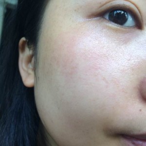 寶雞皮膚病醫(yī)院文東亮醫(yī)生做臉部祛斑效果怎么樣？附臉部祛斑案例