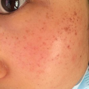 寶雞皮膚病醫(yī)院文東亮醫(yī)生做臉部祛斑效果怎么樣？附臉部祛斑案例