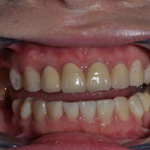 保定東陽口腔醫(yī)院張亞靜醫(yī)生做牙齒冷光美白怎么樣？附冷光美白案例效果對(duì)比圖