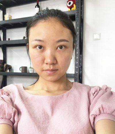 蘇州愛思特醫(yī)療美容醫(yī)院激光祛眼袋術(shù)前效果