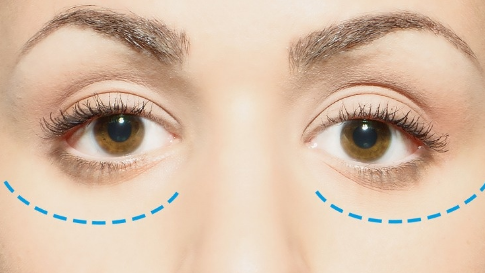 去眼袋失敗修復(fù)價格多少？去眼袋失敗修復(fù)方法？