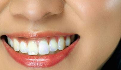 牙齒矯正大概需要花費(fèi)多少錢？