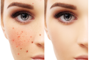 激光祛斑的一般價(jià)格是多少？