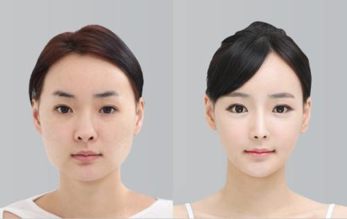 想做歐式雙眼皮，什么是歐式雙眼皮？