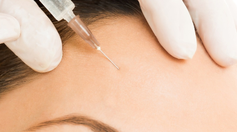 鐳射凈膚是什么？鐳射的效果怎么樣？