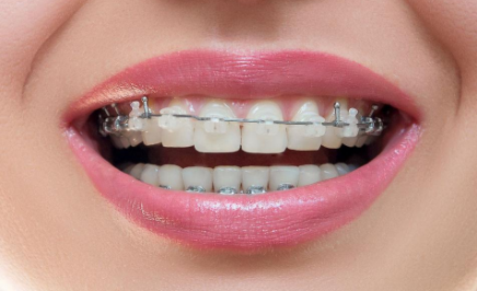 貴金屬烤瓷牙是什么？?jī)r(jià)格大概是多少？