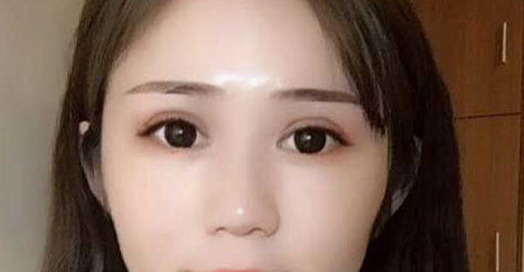 全切雙眼皮消腫的辦法有哪些？