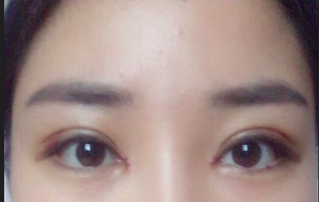 全切雙眼皮后遺癥有哪些？