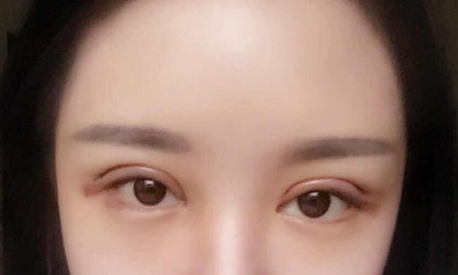 全切雙眼皮手術多少錢一次？