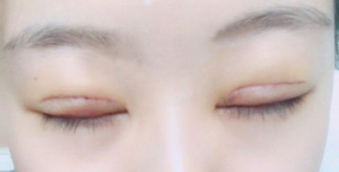 全切雙眼皮術(shù)后會留疤嗎？