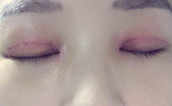 全切雙眼皮不對(duì)稱怎么辦？