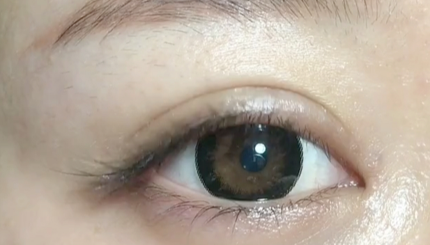 全切雙眼皮失敗可以修復(fù)嗎？