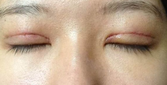全切雙眼皮到底疼不疼？雙眼皮全切需要拆線嗎？
