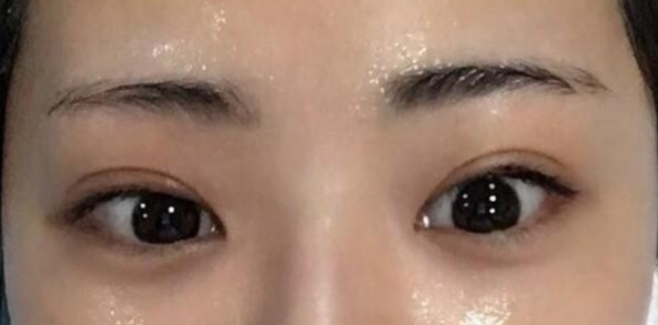 雙眼皮全切的風(fēng)險有哪些？