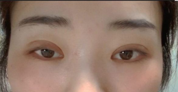 什么是全切雙眼皮？