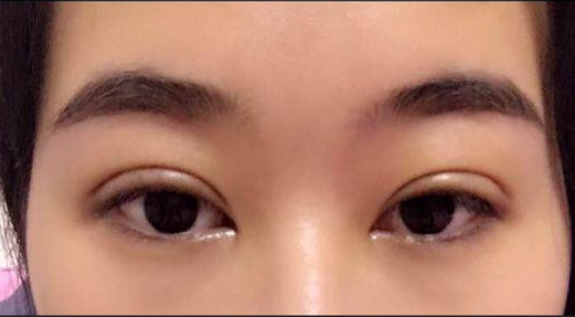 全切雙眼皮的危害有哪些？