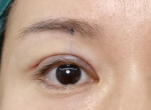 全切雙眼皮會消失嗎？全切雙眼皮多久定型？