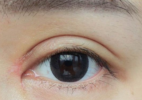 什么是雙眼皮全切？全切雙眼皮拆線多久恢復(fù)？