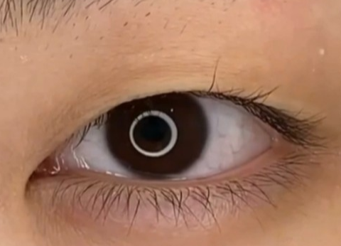 全切雙眼皮疤痕多久能消失？全切雙眼皮幾天可以洗臉？