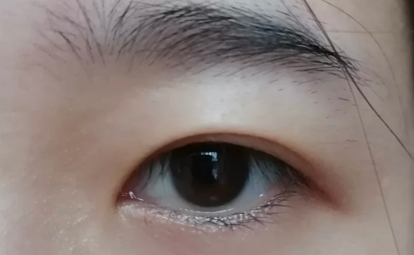 雙眼皮全切好還是韓式三點(diǎn)微創(chuàng)好？