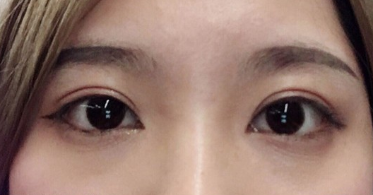 埋線雙眼皮幾天可以碰水？埋線雙眼皮有哪些注意事項(xiàng)？