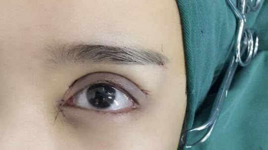 埋線雙眼皮會(huì)不會(huì)脫線？