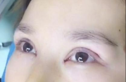 埋線雙眼皮有哪些注意事項(xiàng)？