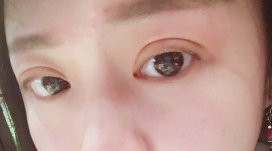埋線雙眼皮可以保持幾年？埋線雙眼皮的危害有哪些？