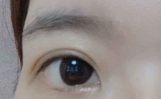 雙眼皮埋線大概多久恢復(fù)？