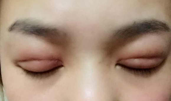 埋線雙眼皮幾天能消腫？