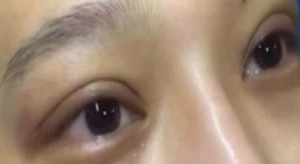 埋線雙眼皮大概能保持幾年??？埋線雙眼皮需要拆線嗎？